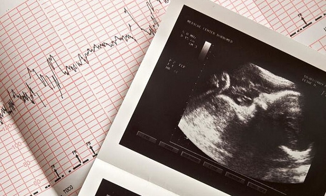 Техас стал первым штатом, где введен запрет на аборты после обнаружения сердцебиения плода